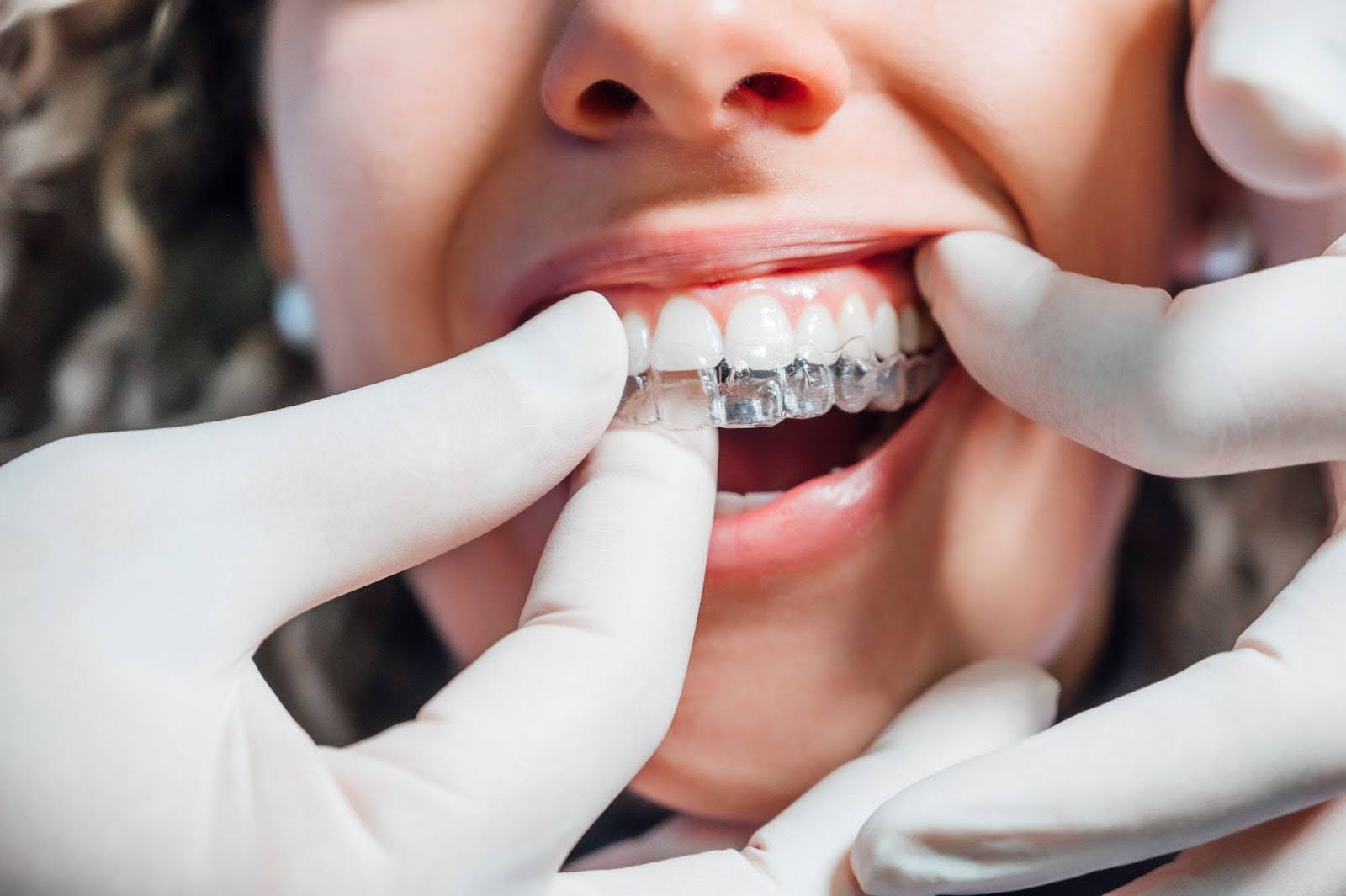 Invisalign Overbite Before and After: Transforming Smiles